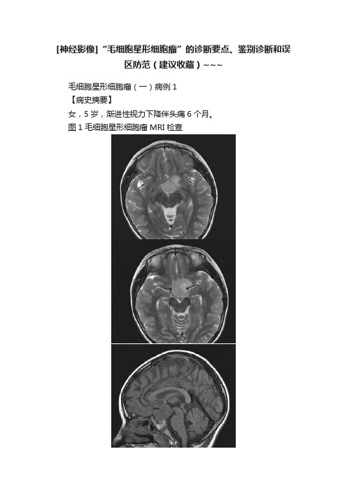 [神经影像]“毛细胞星形细胞瘤”的诊断要点、鉴别诊断和误区防范（建议收藏）~~~