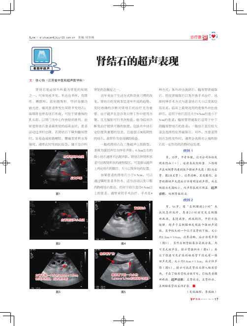 肾结石的超声表现