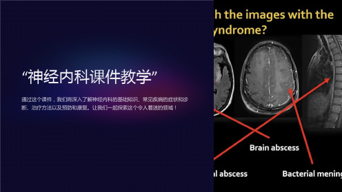 “神经内科课件教学”