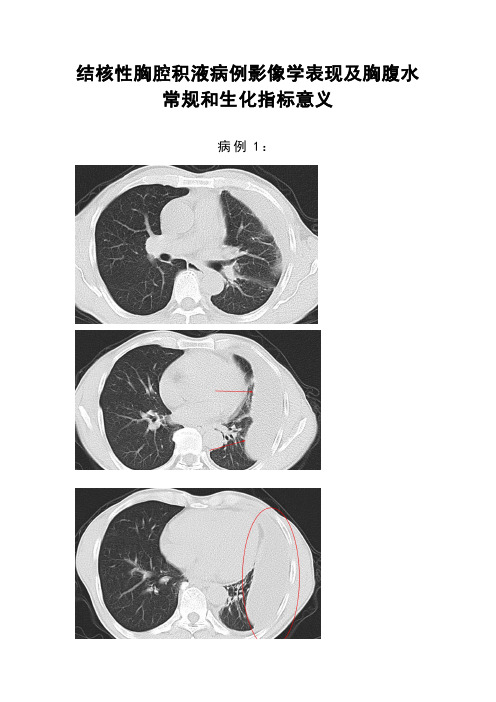 结核性胸腔积液病例影像学表现、胸腹水常规和生化指标意义