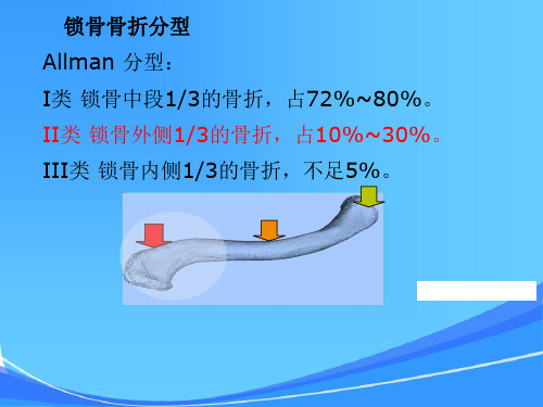 锁骨远端骨折伴肩锁关节脱位治疗