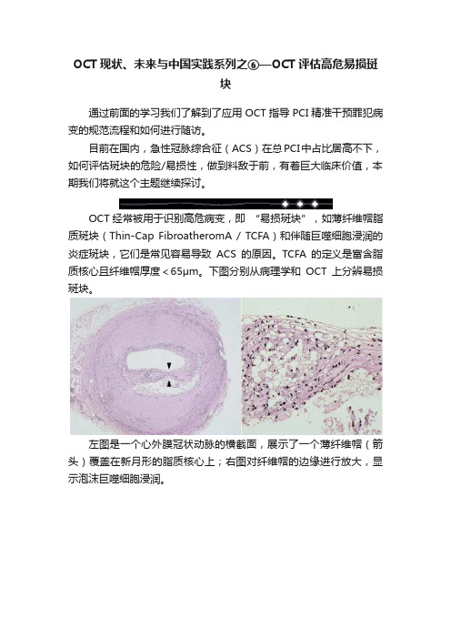 OCT现状、未来与中国实践系列之⑥—OCT评估高危易损斑块