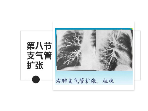 支气管扩张