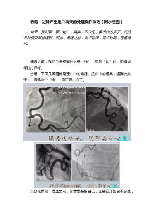 收藏：冠脉严重扭曲病变的处理操作技巧（附示意图）