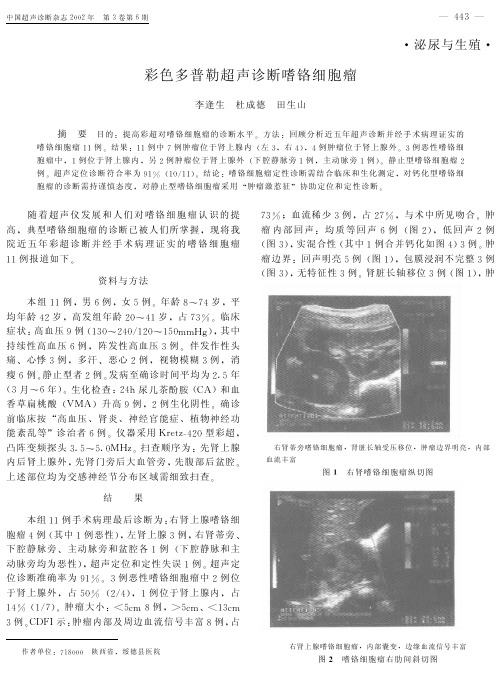 彩色多普勒超声诊断嗜铬细胞瘤