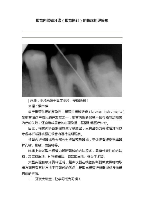 根管内器械分离（根管断针）的临床处理策略