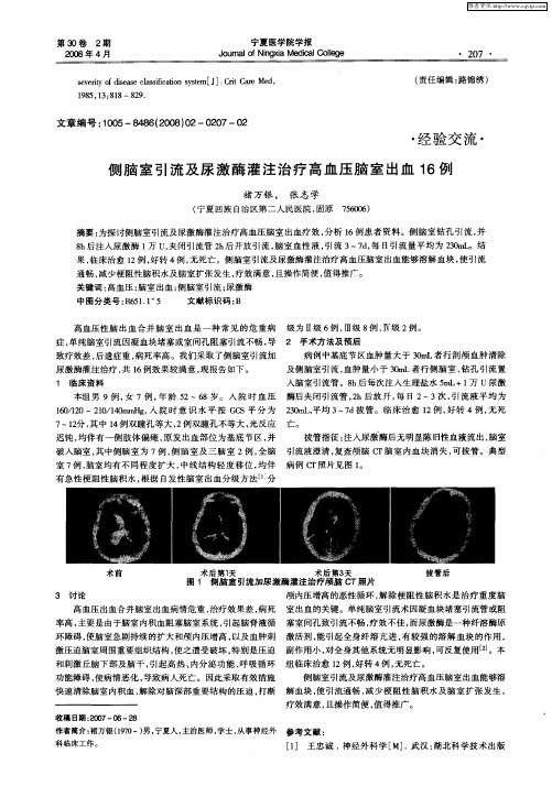 侧脑室引流及尿激酶灌注治疗高血压脑室出血16例