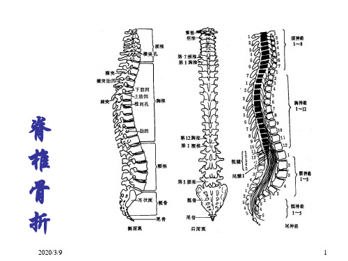 脊柱骨折(-精品医学课件)