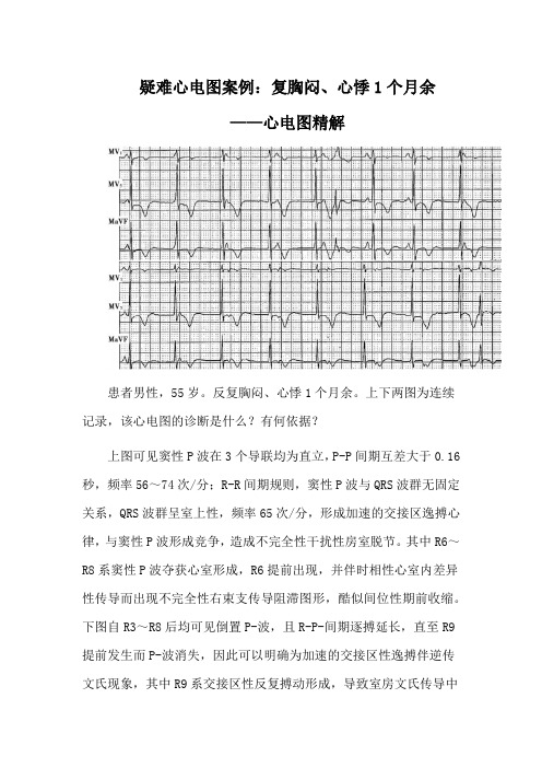 疑难心电图案例：复胸闷、心悸1个月余——心电图精解