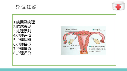 异位妊娠妇女的护理(妇产科护理)