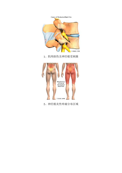 腰椎病、腰间盘突出解剖图