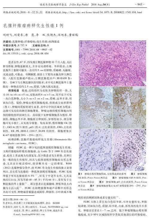 乳腺纤维瘤病样化生性癌1例