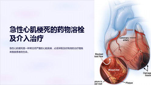 急性心肌梗死的药物溶栓及介入治疗