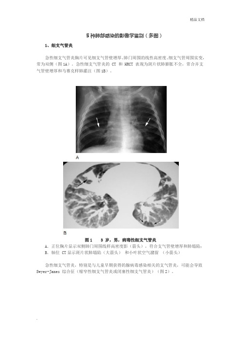 5种肺部感染的影像学鉴别(多图)