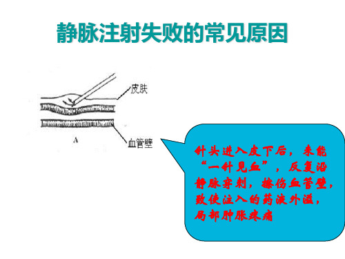 静脉注射失败的常见原因