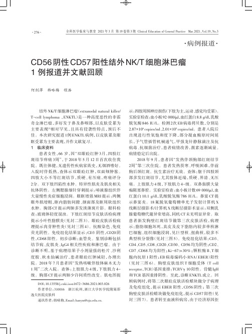 CD56阴性CD57阳性结外NKT细胞淋巴瘤1例报道并文献回顾