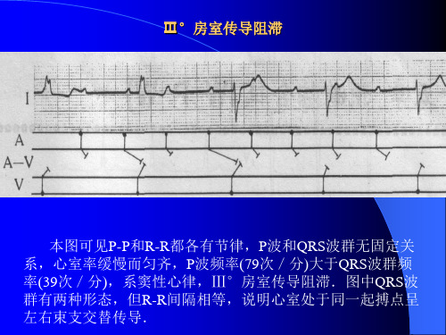 Ⅲ度房室传导阻滞