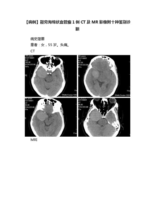 【病例】鞍旁海绵状血管瘤1例CT及MR影像附十种鉴别诊断