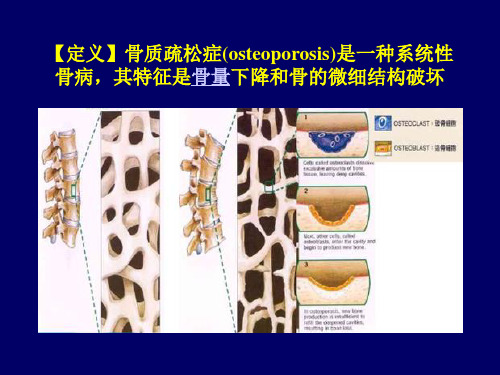 骨质疏松症