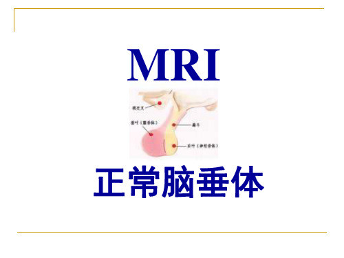 正常垂体MRI(课件)