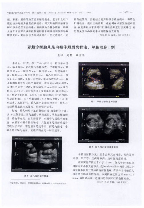 彩超诊断胎儿足内翻伴颅后窝积液、单脐动脉1例