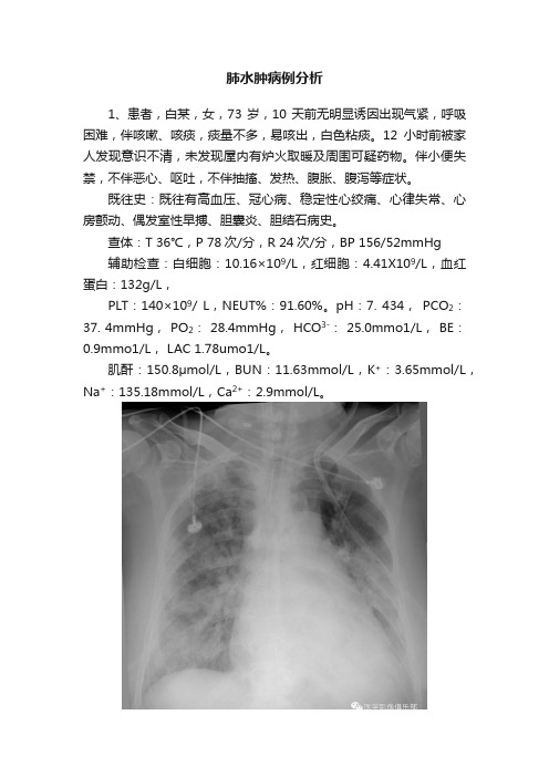 肺水肿病例分析