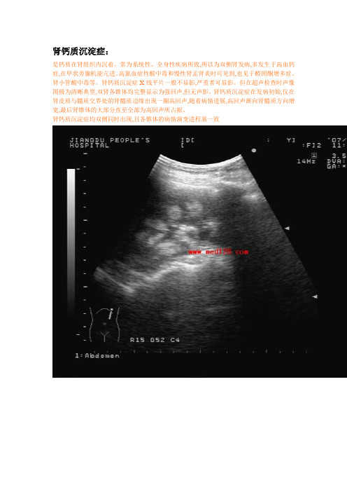 肾钙质沉淀症