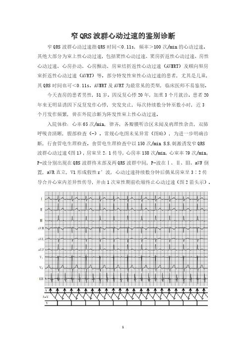 窄QRS波群心动过速的鉴别诊断