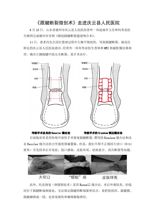 《跟腱断裂微创术》走进庆云县人民医院