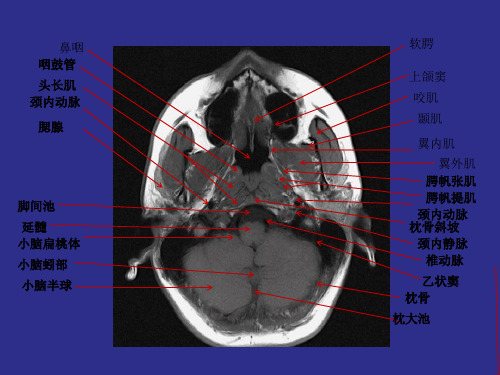 鼻咽部详细MRI断层图谱
