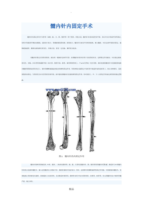 髓内针内固定手术