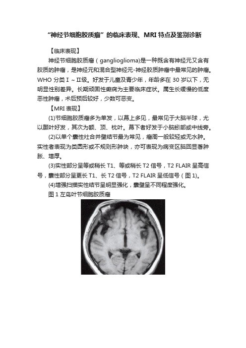 “神经节细胞胶质瘤”的临床表现、MRI特点及鉴别诊断