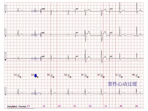 心电图常见正常和异常心电图图谱