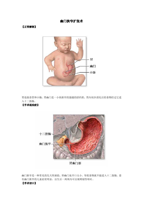 幽门狭窄扩张术