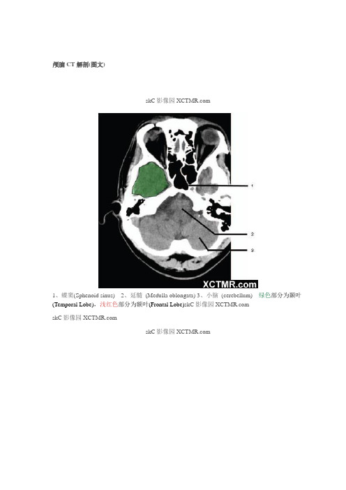 颅脑CT解剖(图文)
