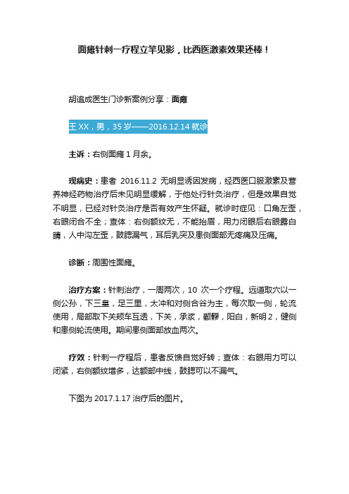 面瘫针刺一疗程立竿见影，比西医激素效果还棒！