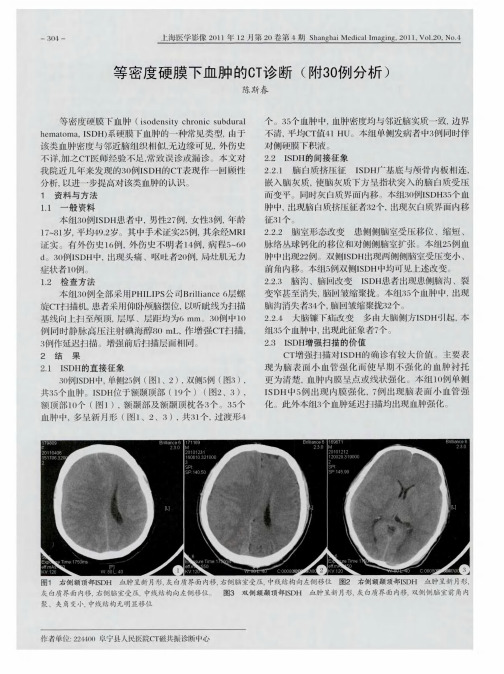 等密度硬膜下血肿的CT诊断(附30例分析)