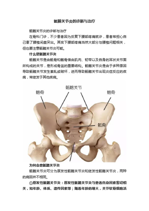 骶髂关节炎的诊断与治疗