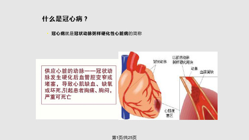 PCI术宣教PPT课件