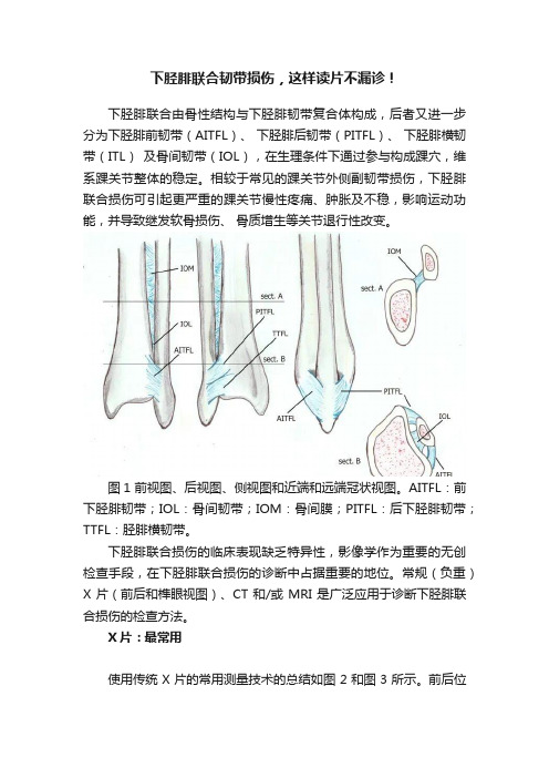 下胫腓联合韧带损伤，这样读片不漏诊！