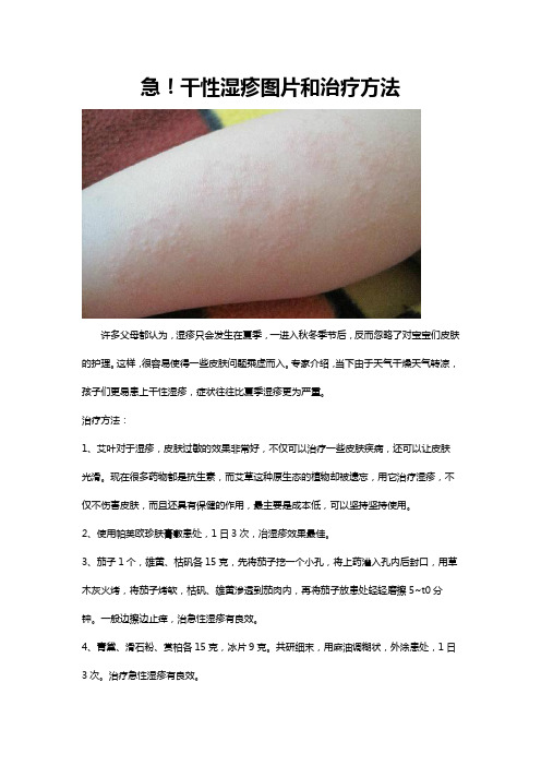 实战经验：干性湿疹图片和治疗方法