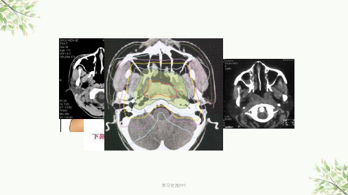 鼻咽癌放射治疗中常见并发症及处理课件
