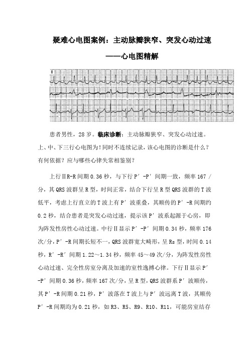 疑难心电图案例：主动脉瓣狭窄、突发心动过速——心电图精解