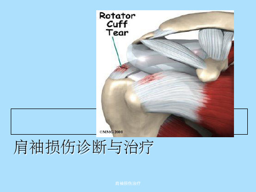 肩袖损伤治疗