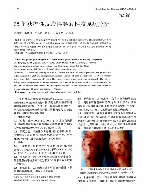 35例获得性反应性穿通性胶原病分析