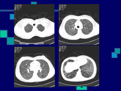 肺CT阅片PPT课件