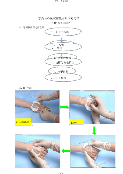 留置针固定方法