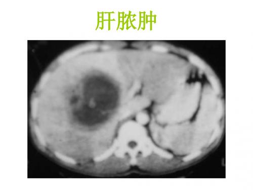 肝脏疾病影像诊断(1)ppt课件