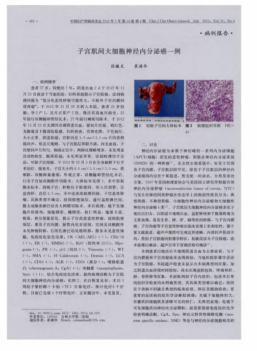 子宫肌问大细胞神经内分泌癌一例