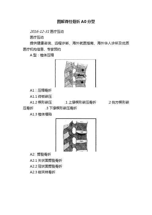 图解脊柱骨折A0分型